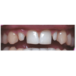 Зубні протези Zirkon Art - NaVolyni.com, Фото 1