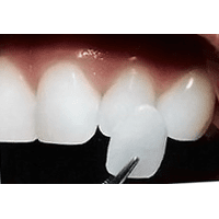 Ламінування зубів