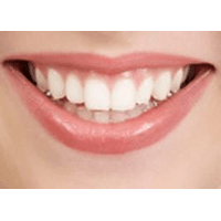 Відбілювання зубів