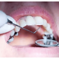 Пломбування зубів ціна