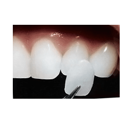 Ламінування зубів