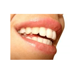 Полірування зубів