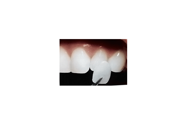 Ламінування зубів - NaVolyni.com