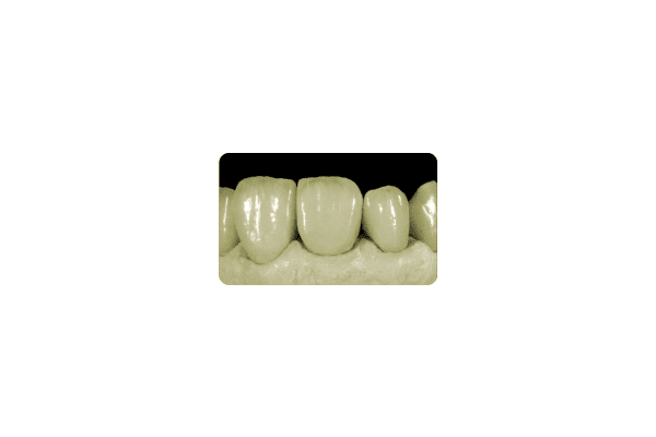 Безметалеві зубні протези - NaVolyni.com