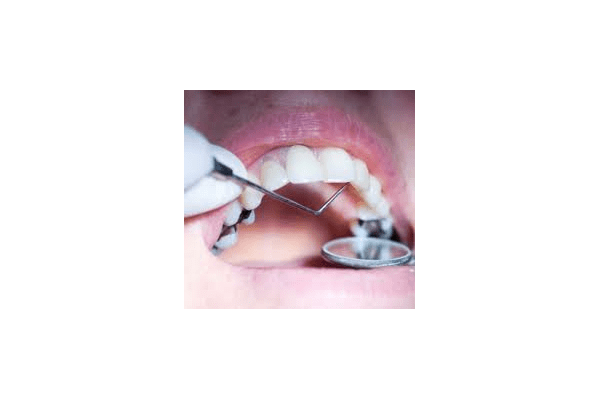 Пломбування зубів ціна - NaVolyni.com