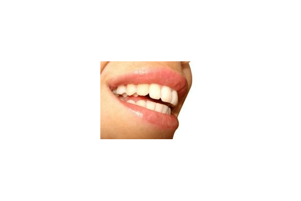 Полірування зубів - NaVolyni.com