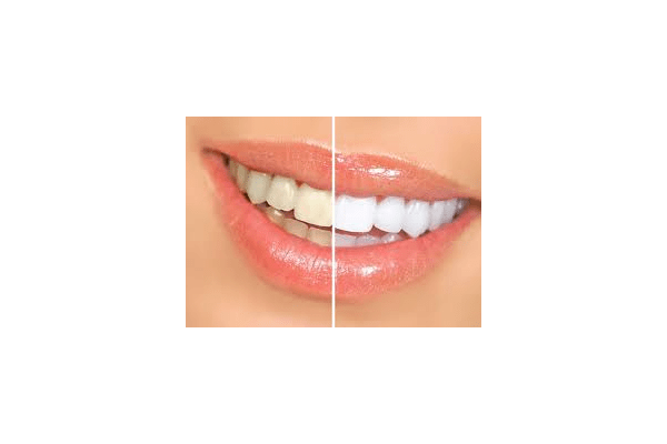Відбілювання зубів - NaVolyni.com